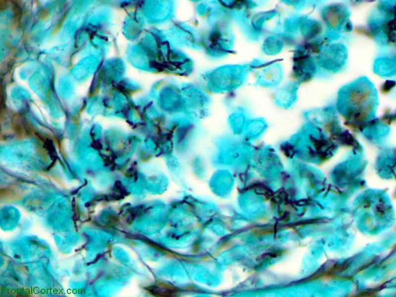 Modified Kinyon stain Nocardia